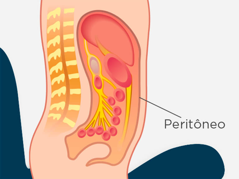 Imagem Carcinomatose Peritoneal