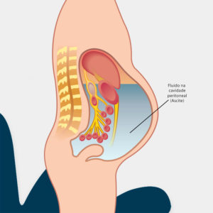 Imagem Carcimatose Peritoneal