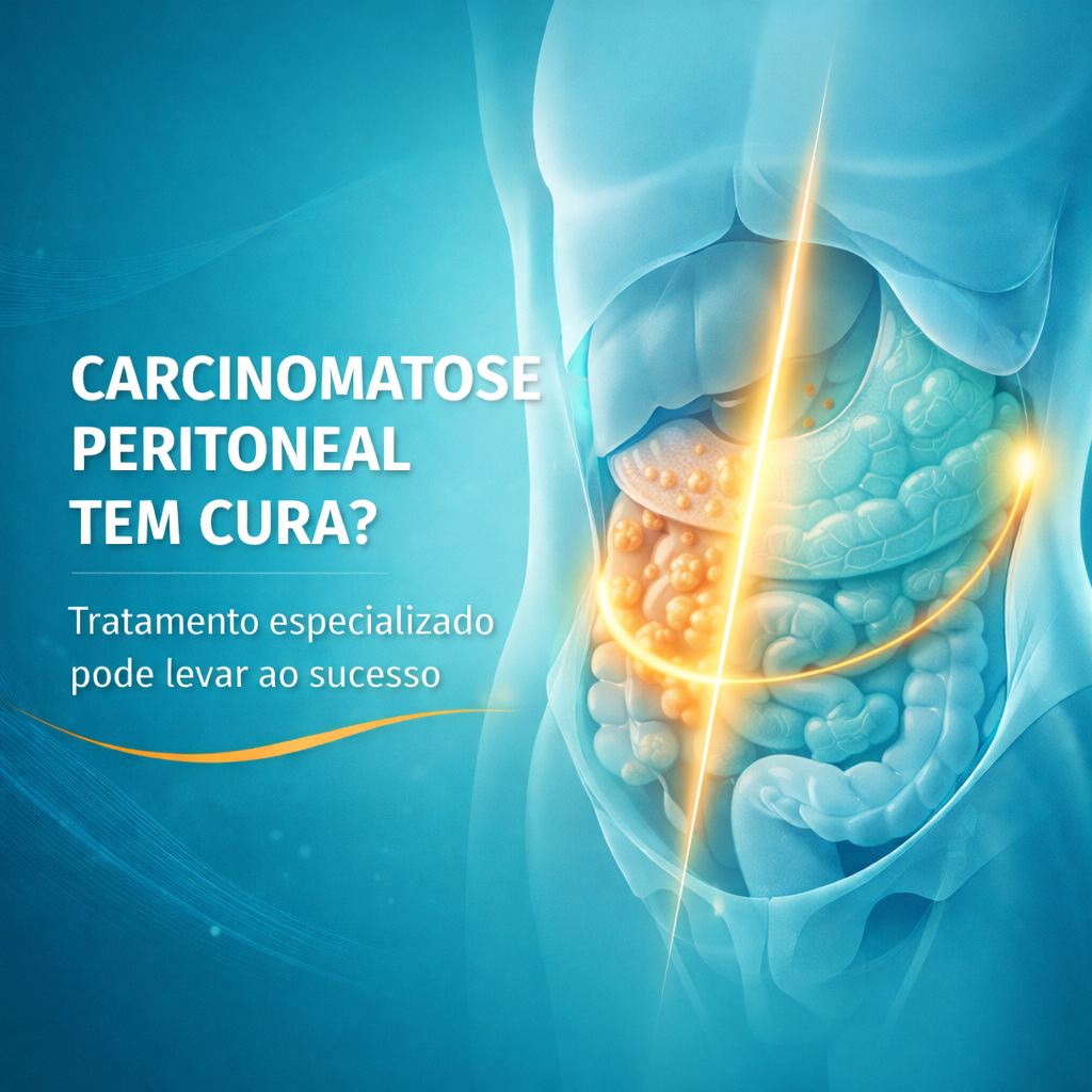 Ilustração médica representando carcinomatose peritoneal e possibilidade de tratamento curativo quando avaliada por especialista em oncologia do peritônio.