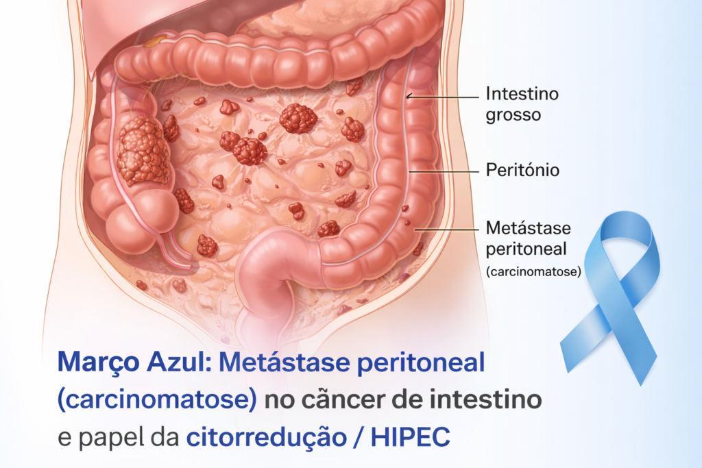 Março Azul: metástase peritoneal (carcinomatose) no câncer de intestino e papel da citorredução/HIPEC